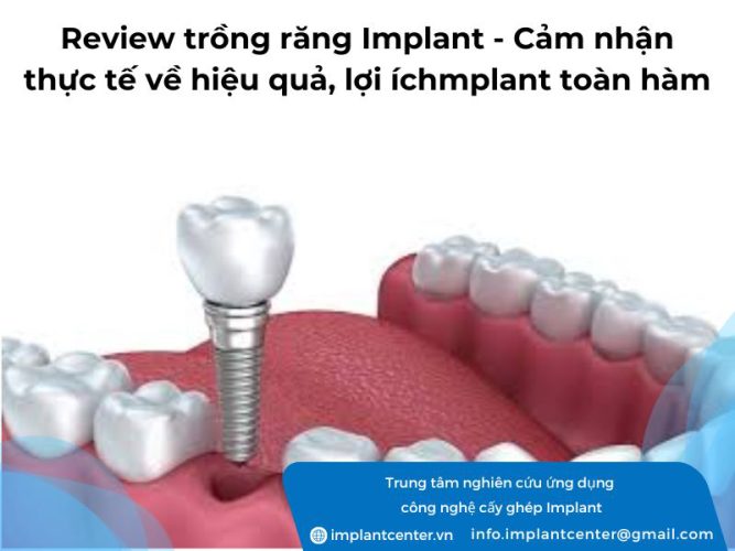 Review trồng răng implant, cảm nhận thực tế về hiệu quả, lợi ích