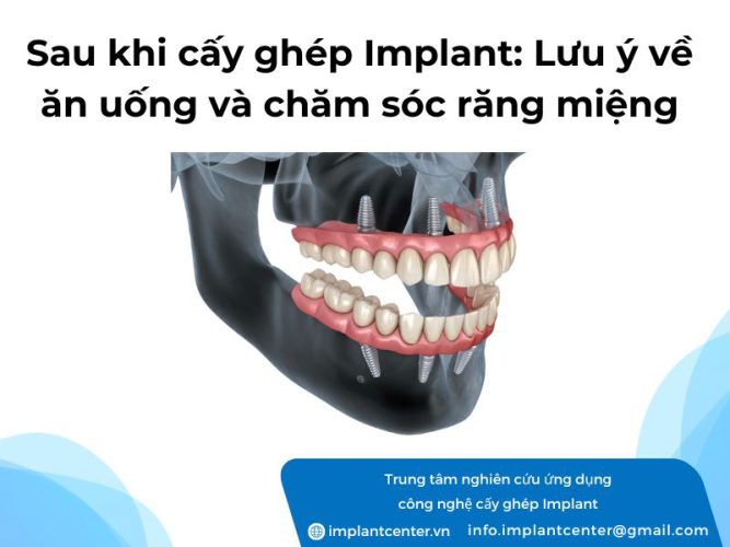 Sau khi cấy ghép Implant cần lưu ý những gì? Chế độ ăn uống và cách chăm sóc răng miệng sau khi trồng Implant mà bạn nên biết