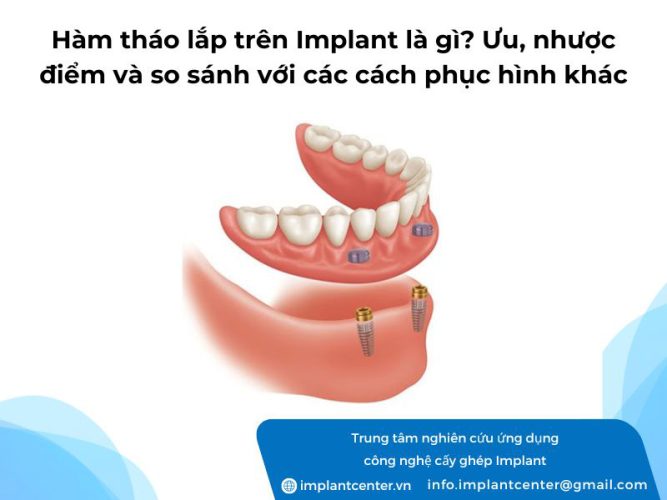 Hàm tháo lắp trên Implant là gì? Ưu, nhược điểm và so sánh cách phục hình khác