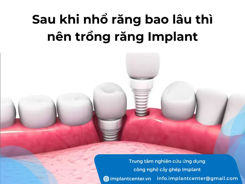 Sau khi nhổ răng bao lâu thì trồng Implant