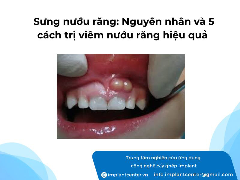 Sưng nướu răng: Nguyên nhân và 5 cách trị viêm nướu răng hiệu quả