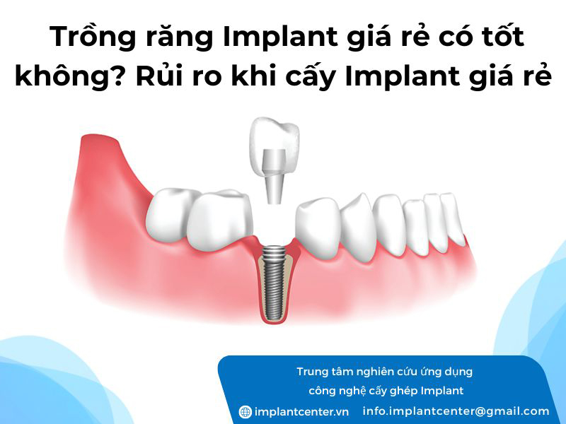 Trồng răng Implant giá rẻ có tốt không? Rủi ro khi cấy Implant giá rẻ