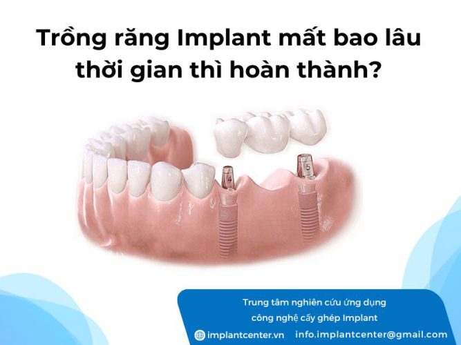 Trồng răng implant mất bao lâu thời gian thì hoàn thành