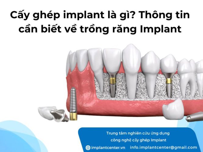 Trồng răng Implant là gì? Thông tin cần biết về trồng răng Implant