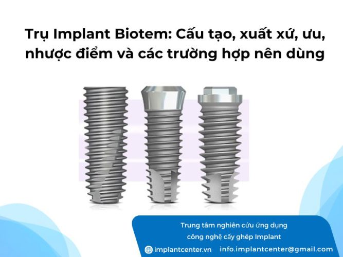 Trụ Implant Biotem: cấu tạo, xuất xứ, ưu nhược điểm và các trường hợp nên thực hiện