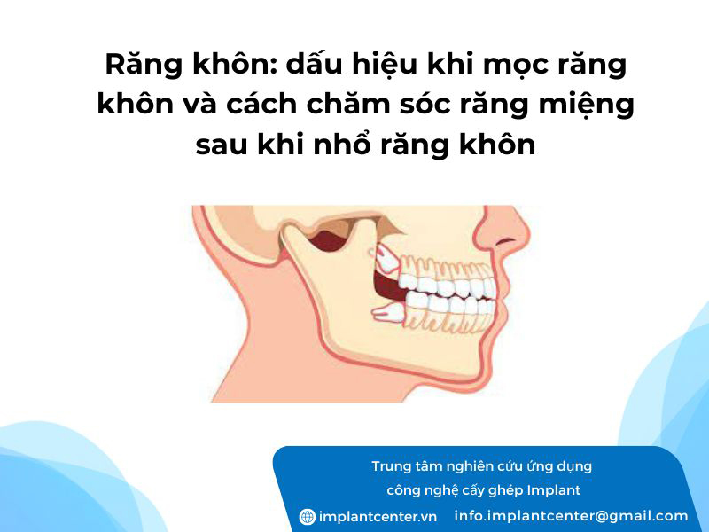 Răng khôn: dấu hiệu khi mọc răng và cách chăm sóc răng miệng sau khi nhổ răng khôn