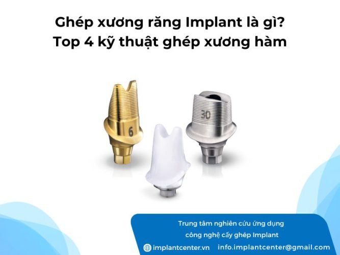 Ghép xương răng Implant là gì? Top 4 kỹ thuật ghép xương hàm