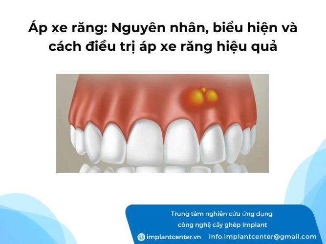 Áp xe răng: Nguyên nhân, biểu hiện và cách điều trị áp xe răng hiệu quả