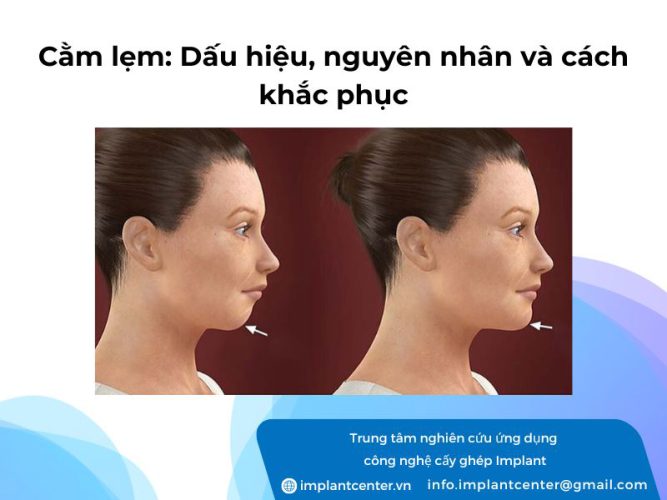 Cằm lẹm: dấu hiệu nguyên nhân và cách khắc phục