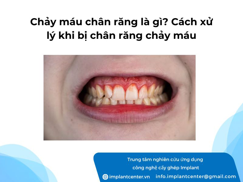 Chảy máu chân răng là gì? Cách xử lý khi chân răng bị chảy máu