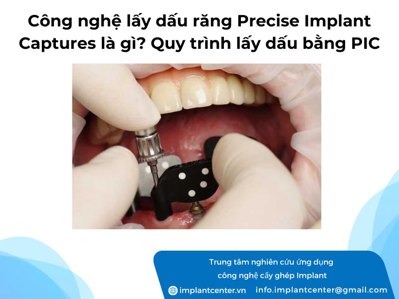 Công nghệ lấy dấu răng Precise Implant Captures là gì? Quy trình lấy dấu bằng PIC