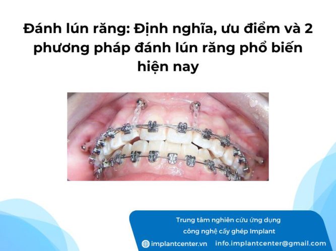 Đánh lún răng: định nghĩa, ưu điểm và 2 phương pháp đánh lún răng phổ biến hiện nay