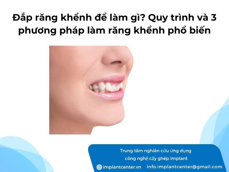 Đắp răng khểnh để làm gì? Quy trình và 3 phương pháp làm răng khểnh phổ biến