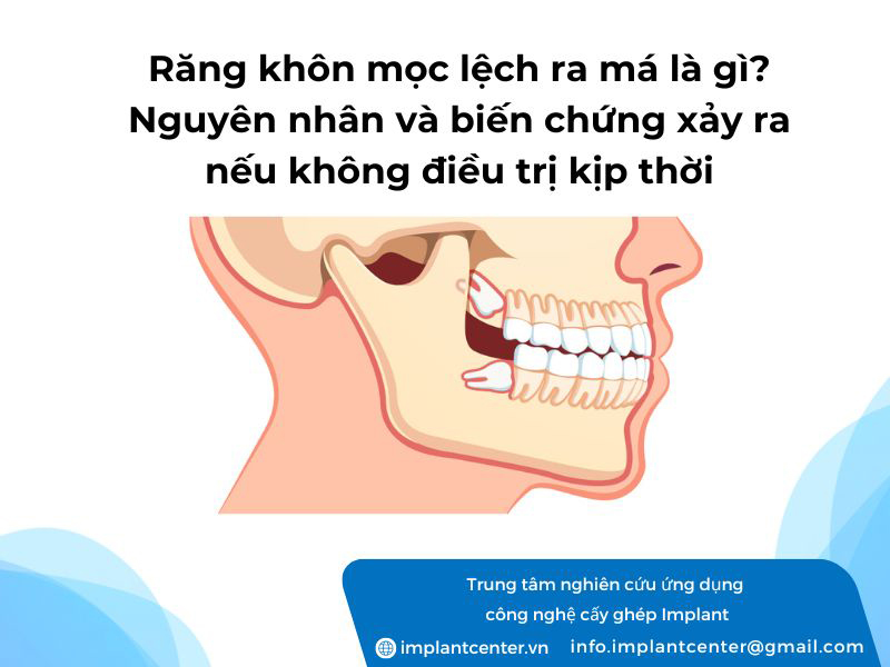 Dấu hiệu răng khôn mọc lệch ra má là gì? Nguyên nhân và biến chứng xảy ra nếu không điều trị kịp thời