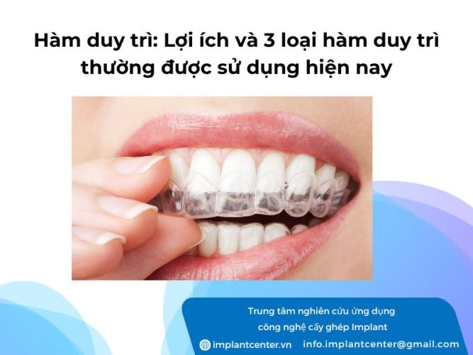 Hàm duy trì: lợi ích và 3 loại hàm duy trì thường được sử dụng hiện nay