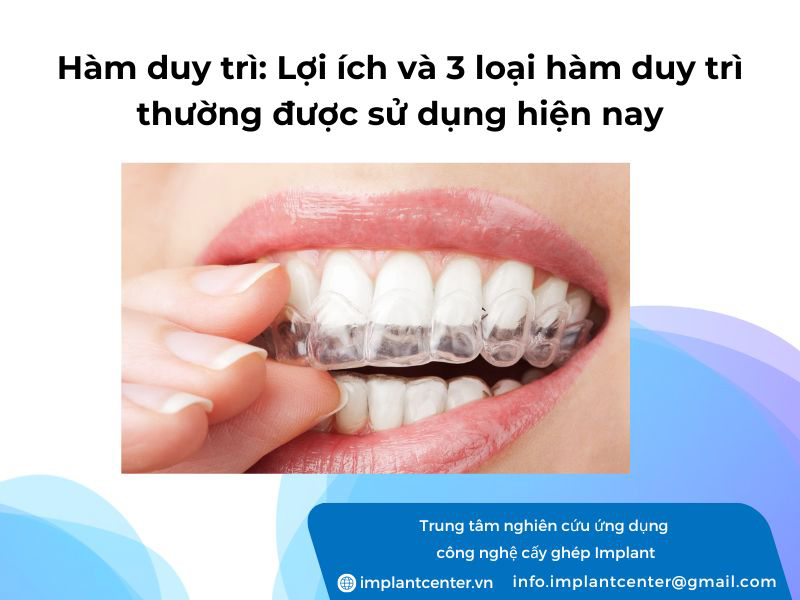 Hàm duy trì: lợi ích và 3 loại hàm duy trì thường được sử dụng hiện nay