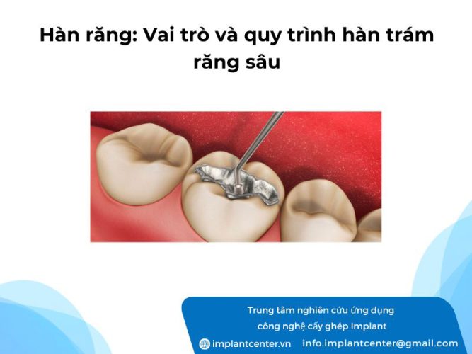 Hàn răng vai trò và quy trình hàn trám răng sâu