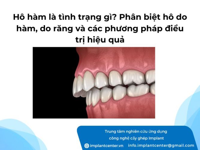 Hô hàm là tình trạng gì? Phân biệt hô do hàm do răng và các phương pháp điều trị hiệu quả