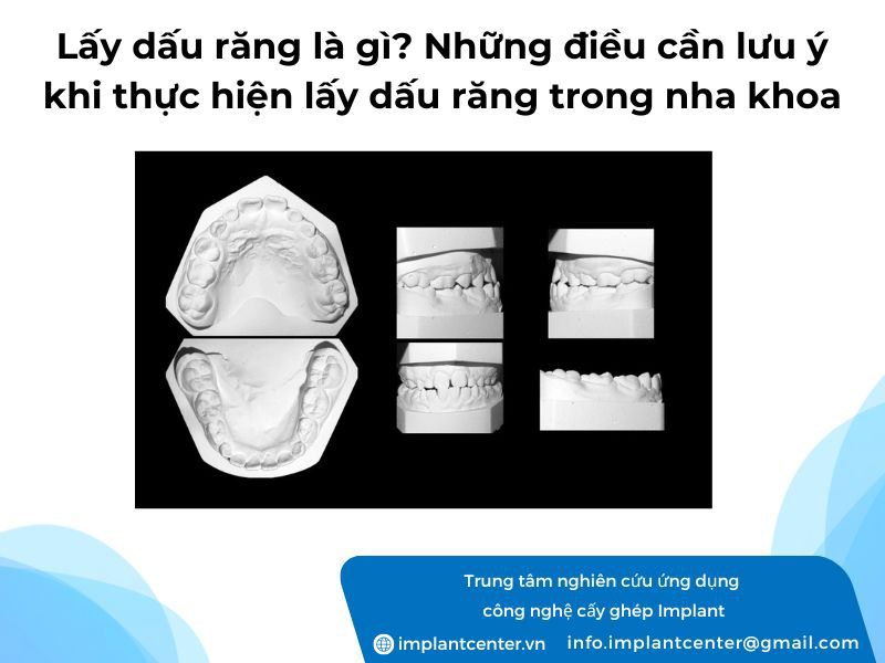 Lấy dấu răng là gì? Những điều cần lưu ý khi thực hiện lấy dấu răng trong nha khoa
