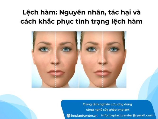 Lệch hàm: nguyên nhân, tác hại và cách khắc phục tình trạng lệch hàm