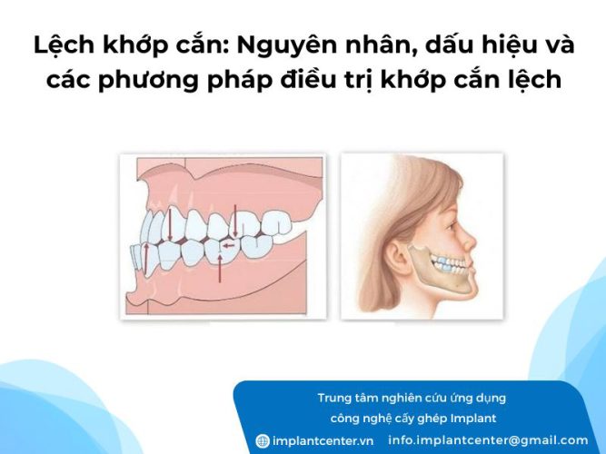 Lệch khớp cắn: nguyên nhân, dấu hiệu và các phương pháp điều trị khớp cắn lệch