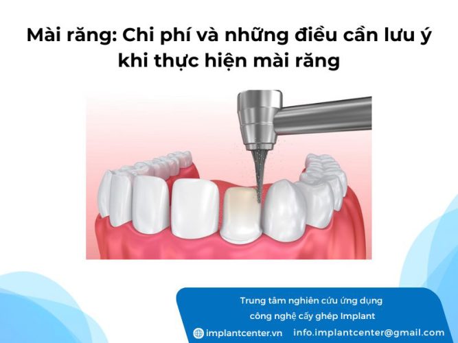 Mài răng: chi phí và những điều cần lưu ý khi thực hiện mài răng