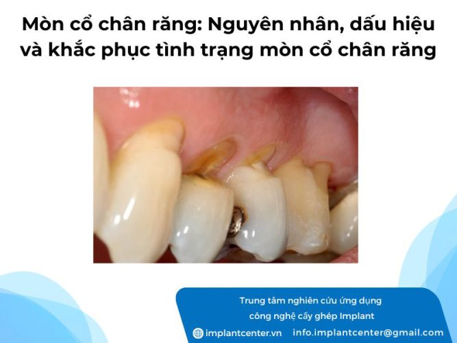 Mòn cổ chân răng: nguyên nhân, dấu hiệu và cách khắc phục tình trạng mòn cổ chân răng