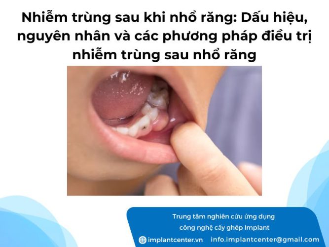 Nhiễm trùng sau khi nhổ răng: dấu hiệu, nguyên nhân và các phương pháp điều trị nhiễm trùng sau nhổ răng