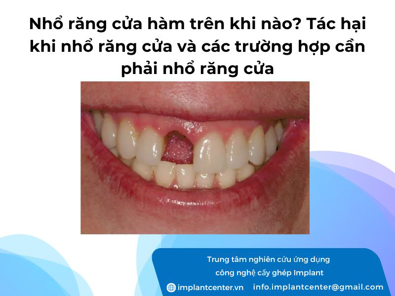 Nhổ răng cửa hàm trên khi nào? Tác hại khi nhổ răng của và các trường hợp cần phải nhổ răng cửa