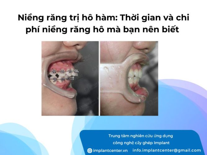 Niềng răng trị hô hàm: thời gian và chi phí niềng răng hô mà bạn nên biết
