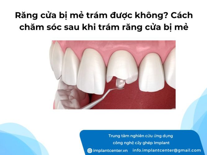 Răng cửa bị mẻ trám được không? Cách chăm sóc sau khi trám răng cửa bị mẻ