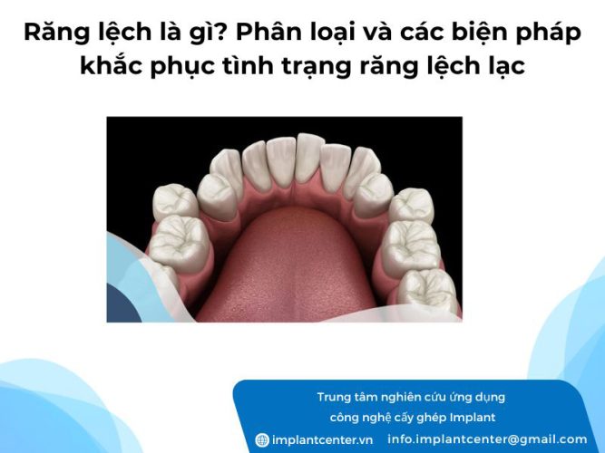 Răng lệch là gì? Phân loại và các biện pháp khắc phục tình trạng răng lệch lạc