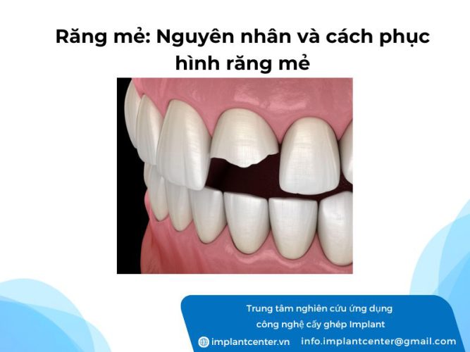 Răng mẻ: nguyên nhân và cách phục hình răng mẻ