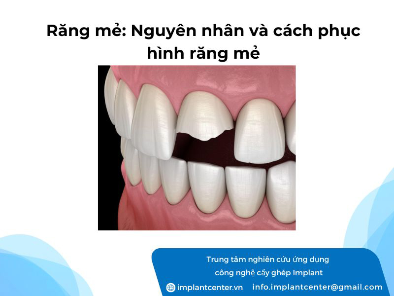 Răng mẻ: nguyên nhân và cách phục hình răng mẻ