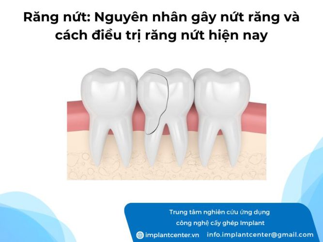 Răng nứt: nguyên nhân gây nứt răng và cách điều trị răng nứt hiện nay