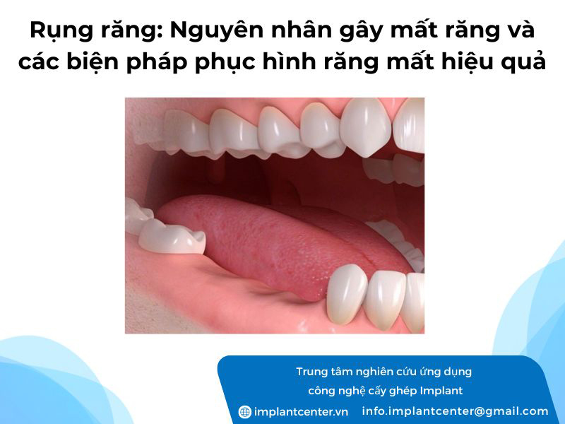 Rụng răng: nguyên nhân gây mất răng và các biện pháp phục hình răng mất hiệu quả