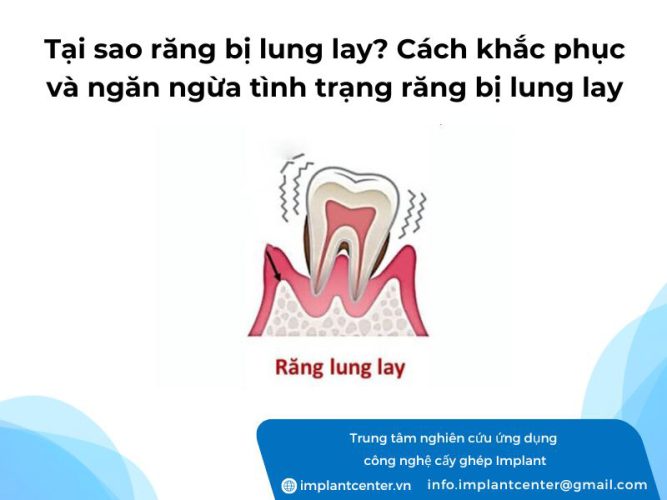 Tại sao răng bị lung lay: cách khắc phục và ngăn ngừa tình trạng răng bị lung lay