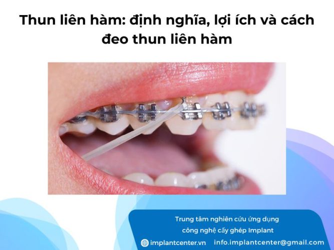 Thun liên hàm: định nghĩa, lợi ích và cách đeo thun liên hàm