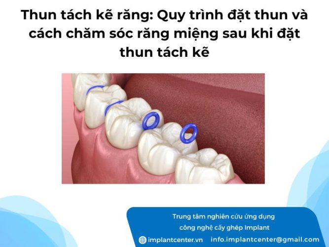 Thun tách kẽ răng dùng để làm gì? Quy trình đặt thun và cách chăm sóc răng miệng sau khi đặt thun tách kẽ