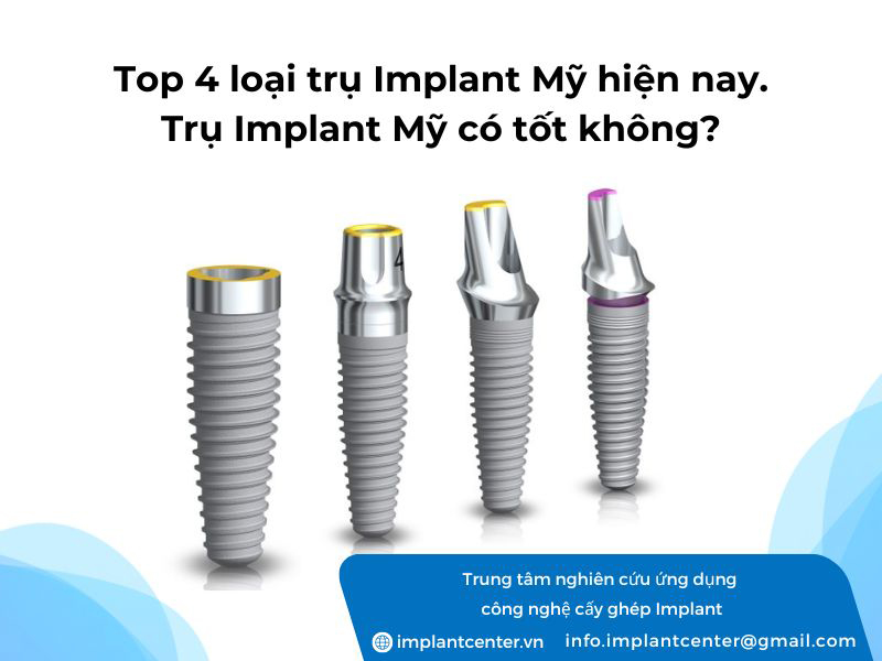 Top 4 loại trụ Implant Mỹ hiện nay: Trụ Implant Mỹ có tốt không
