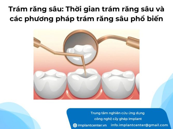 Trám răng sâu: thời gian trám răng sâu và các phương pháp trám răng sâu phổ biến