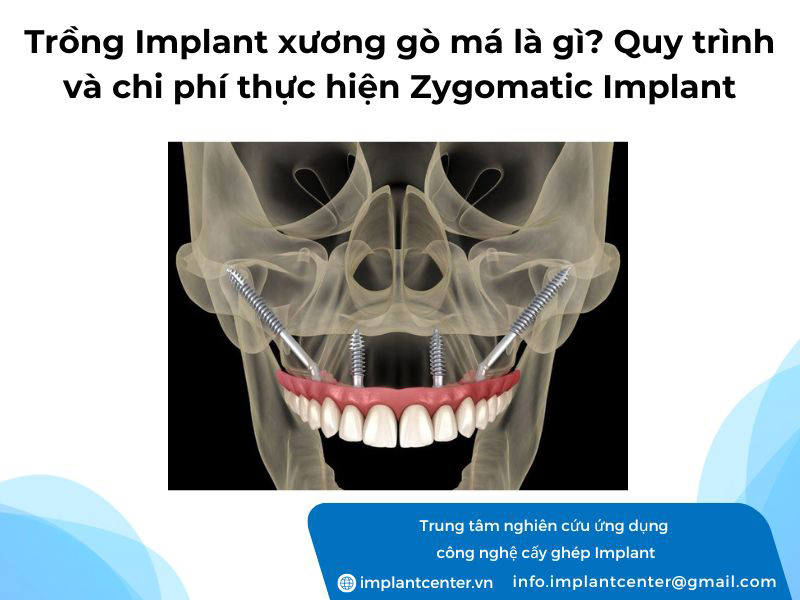 Trồng Implant xương gò má là gì? Quy trình và chi phí thực hiện Zygomatic Implant