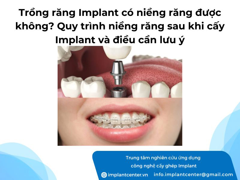Trồng răng Implant có niềng răng được không? Quy trình niềng răng sau khi cấy Implant và điều cần lưu ý