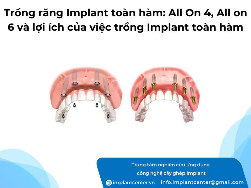 Trồng răng Implant toàn hàm All on 4 All on 6 và lợi ích của việc trồng Implant toàn hàm