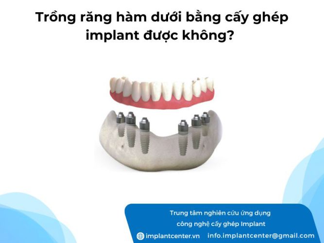 Trồng răng hàm dưới bằng cấy ghép Implant được không