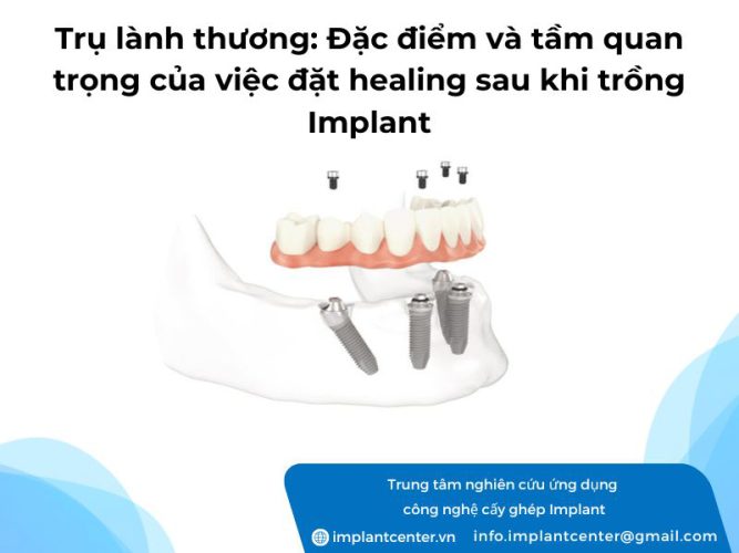 Trụ lành thương: đặc điểm và tầm quan tọng của việc đặt healing sau khi trồng Implant