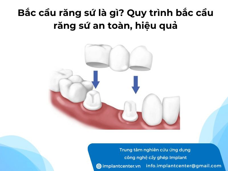 Bắc cầu răng sứ là gì? Quy trình bắc cầu răng sứ an toàn, hiệu quả