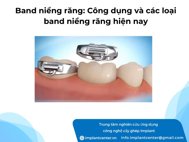 Band niềng răng: Công dụng và các loại band niềng răng hiện nay