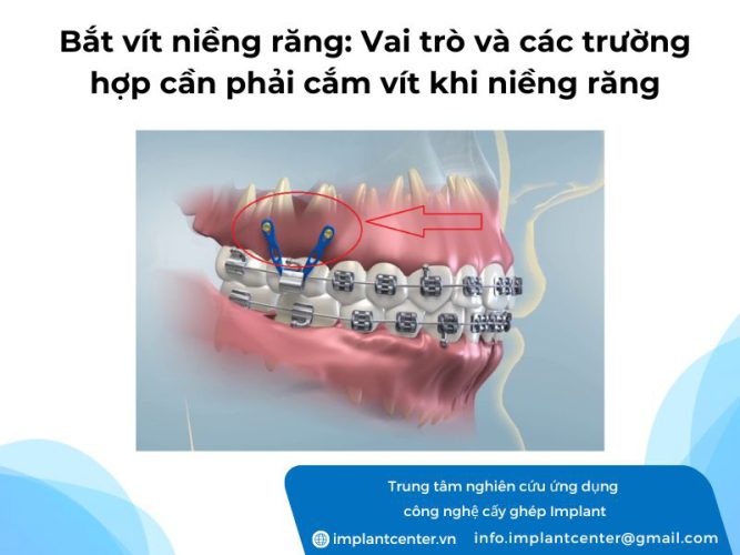 Bắt vít niềng răng: Vai trò và các trường hợp cần phải cắm vít khi niềng răng
