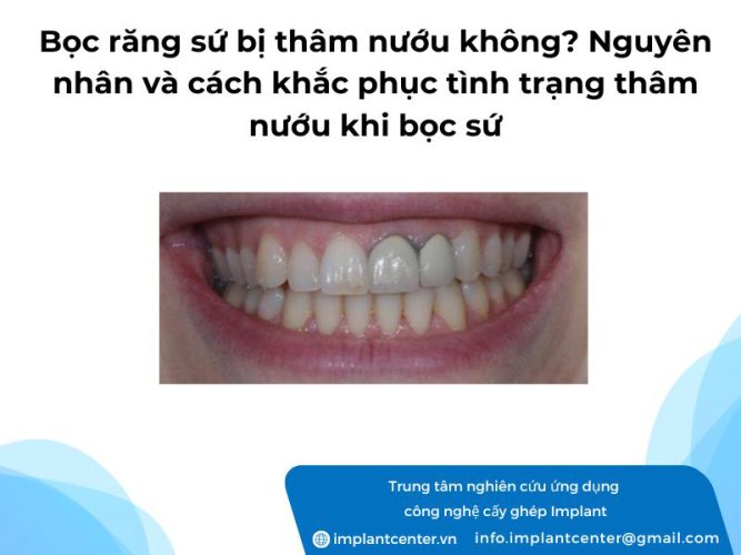 Bọc răng sứ bị thâm nướu không? Nguyên nhân và cách khắc phục tình trạng thâm nướu khi bọc sứ